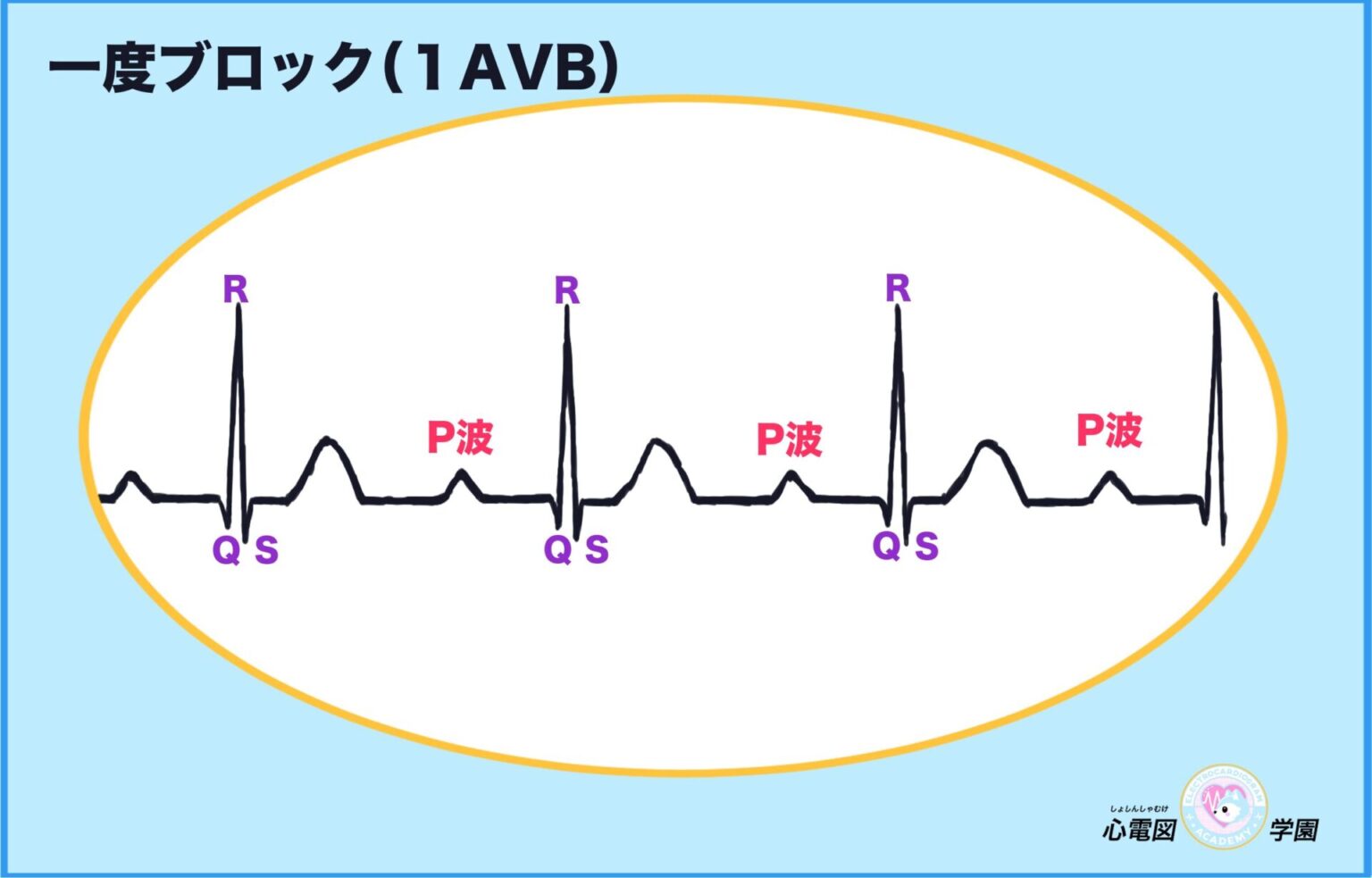 【初心者向け】これでなっとく！一度ブロック（1AVB）の見分け方 – 心電図学園