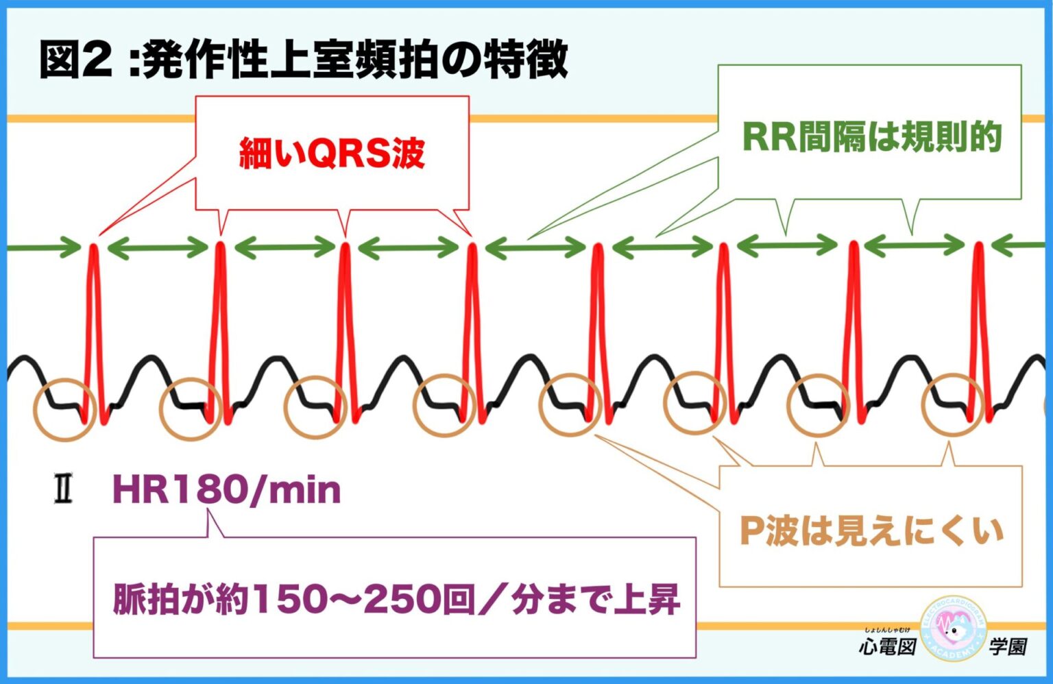 【初心者向け】これでなっとく！発作性上室性頻拍（PSVT）の見分け方 – 心電図学園