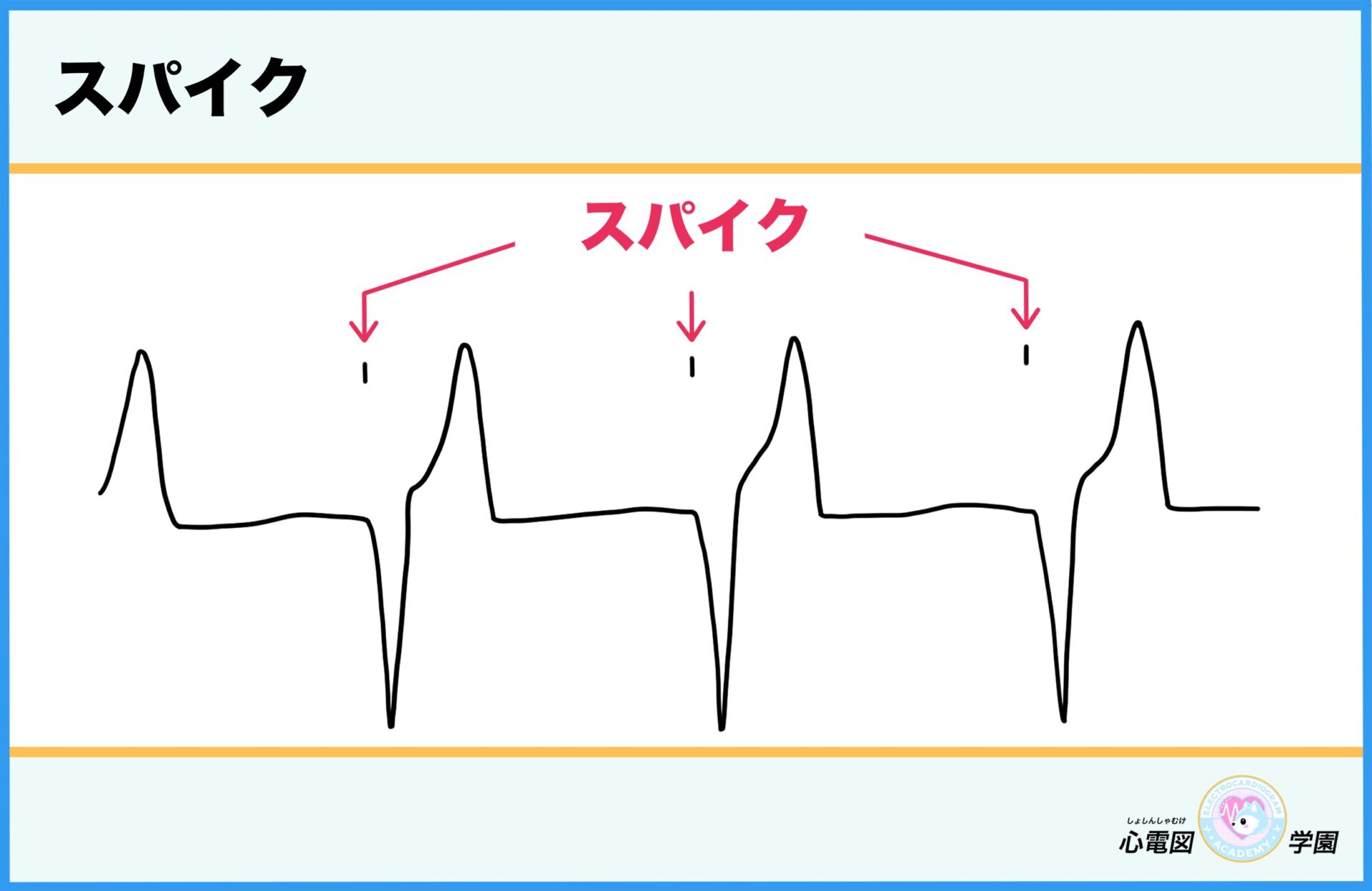 【初心者向け】はじめてのペースメーカー波形〜これでなっとく!ペースメーカー波形の見分け方〜 – 心電図学園